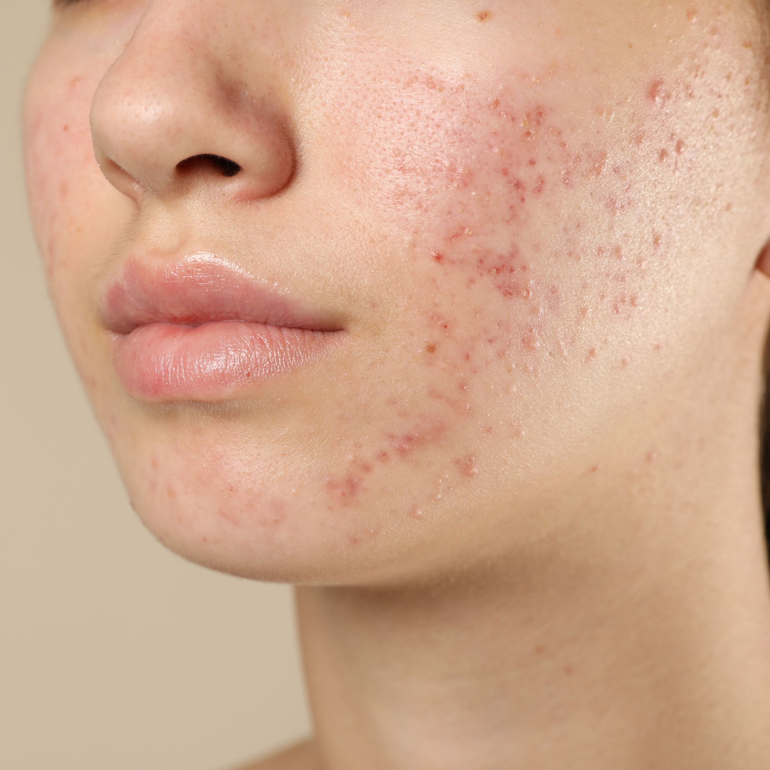 ACNE/BREAKOUTS